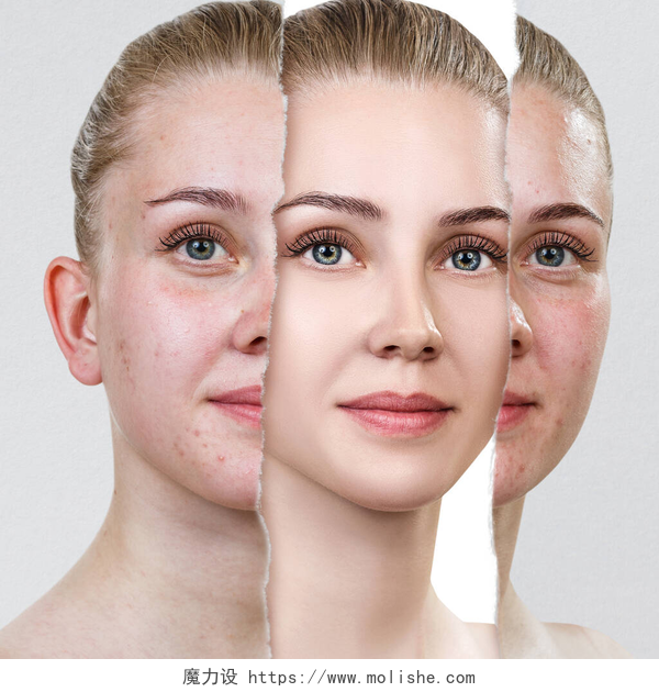 妇女皮肤治疗前后照片对比图旧照片与粉刺及新健康皮肤的比较.